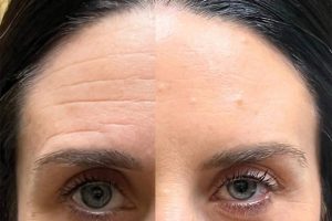 Summer-Smooth Confidence: A Naturally Refreshed Look with Dysport at Complexions Med Spa